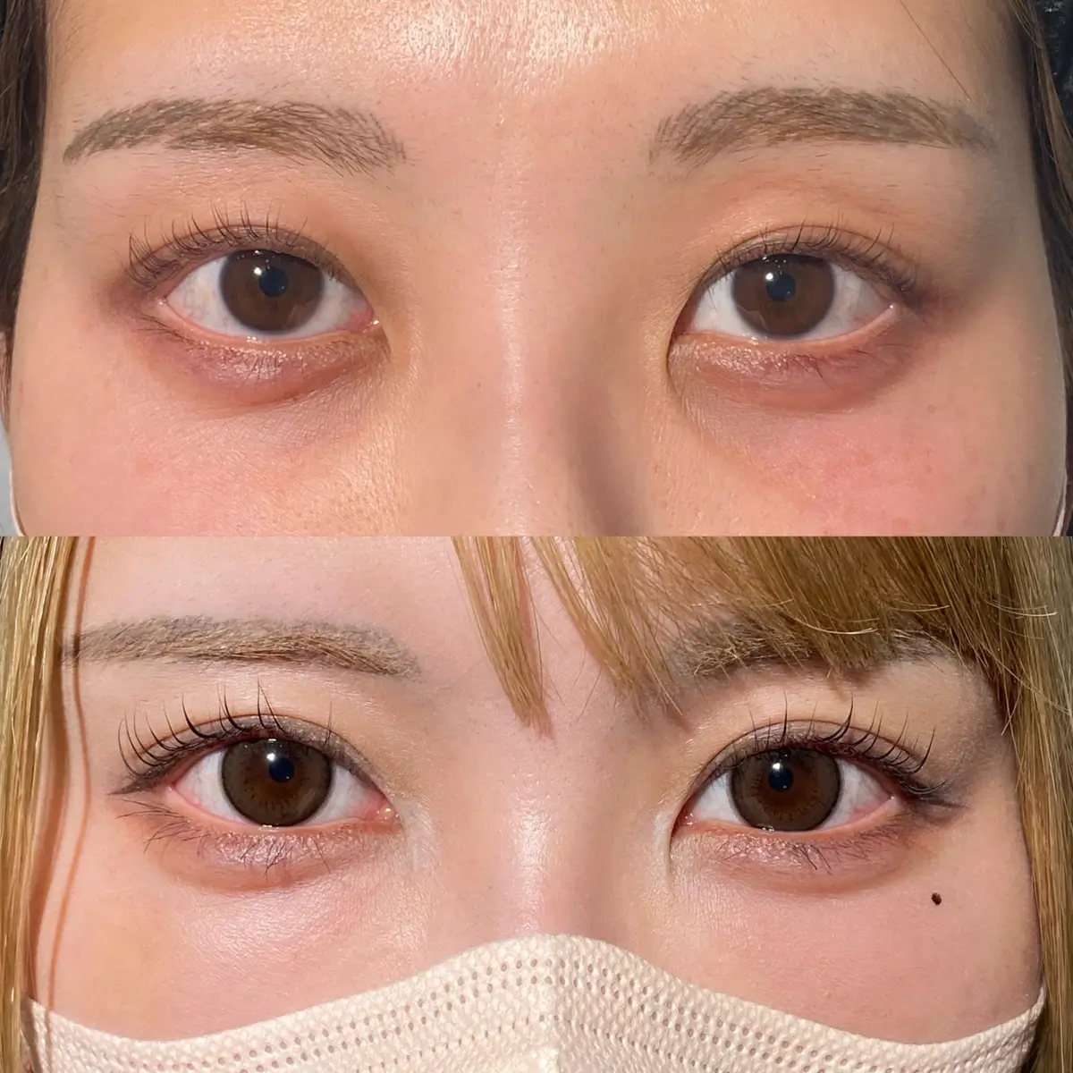 incision ba01